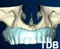 Teeth-in-an-hour d'implants pour des mâchoires édentées bangkok thailand